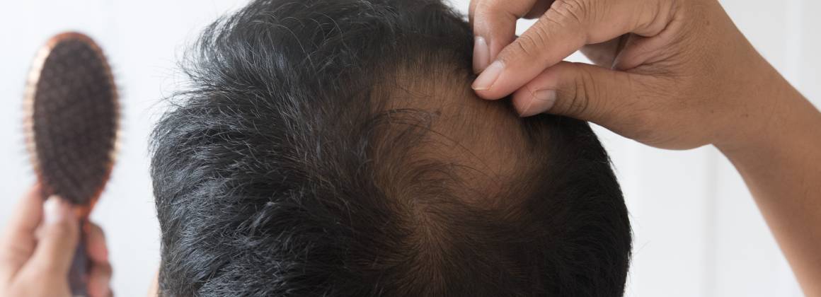 Ricrescita dei capelli diradati: Cause, sintomi e trattamenti per la perdita e la ricrescita dei capelli