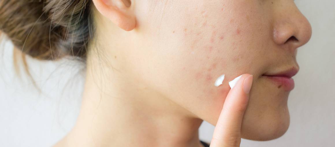 Come posso prevenire l'acne in modo naturale?