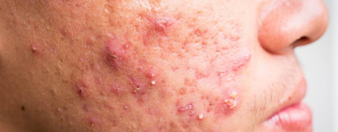 Quali sono i cibi spazzatura per l'acne?