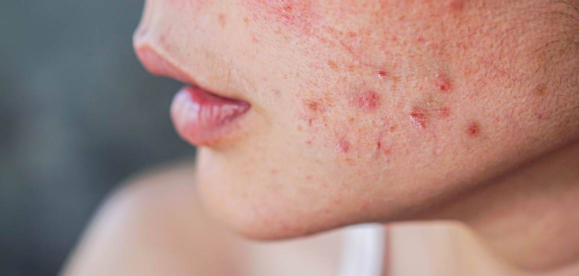 Porque é que, de repente, estou a ficar com acne grave?