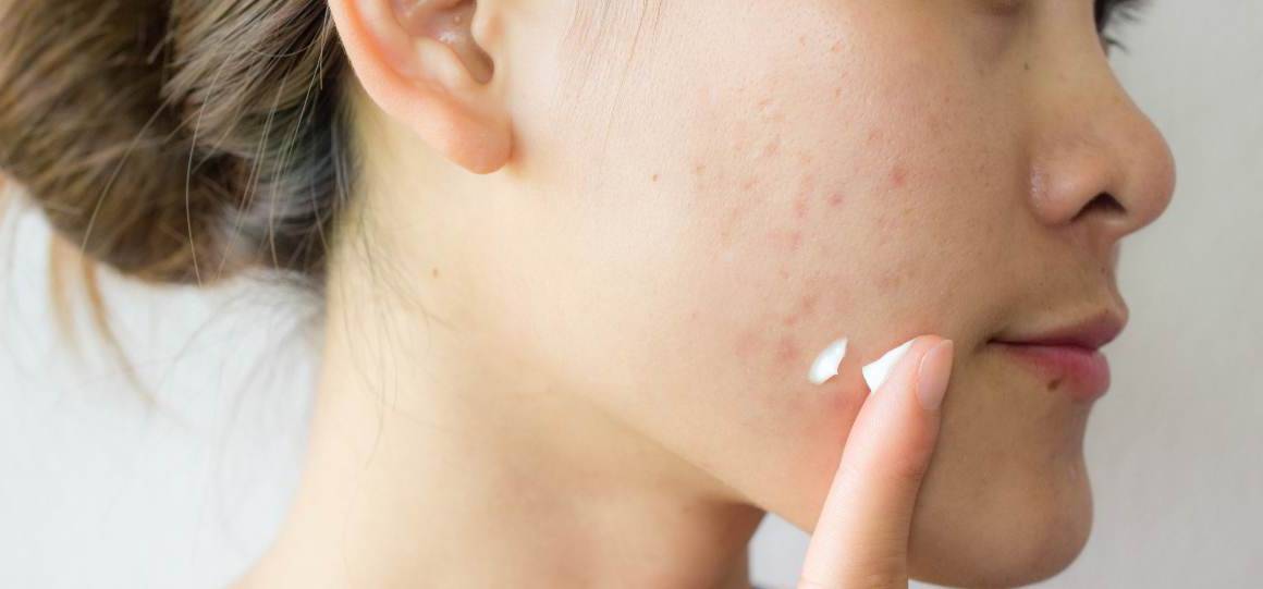 Lo zucchero provoca l'acne?